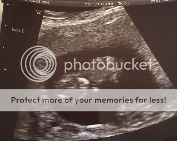 Fab 10 week scan identical twins BabyCenter